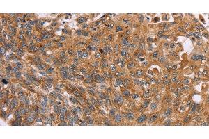 Immunohistochemistry of paraffin-embedded Human esophagus cancer tissue using PMPCB Polyclonal Antibody at dilution 1:50 (PMPCB anticorps)