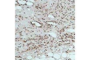 Immunohistochemical analysis of CALHM1 staining in human Hepatocancer formalin fixed paraffin embedded tissue section. (CALHM1 anticorps)