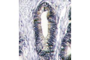 Formalin-fixed and paraffin-embedded human breast carcinoma reacted with EphB2 Antibody (C-term) (ABIN391920 and ABIN2841730) , which was peroxidase-conjugated to the secondary antibody, followed by DAB staining. (EPH Receptor B2 anticorps  (C-Term))