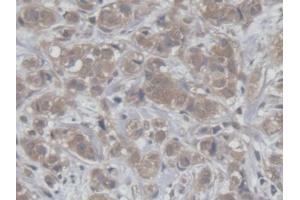 DAB staining on IHC-P; Samples: Human Breast cancer Tissue (HCFC1 anticorps  (AA 52-258))