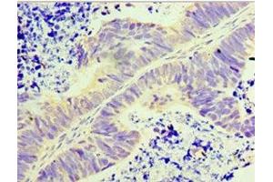 Immunohistochemistry of paraffin-embedded human ovarian cancer using ABIN7154181 at dilution of 1:100 (GLYATL1 anticorps  (AA 1-302))