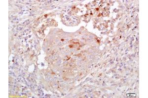 Formalin-fixed and paraffin embedded human colon carcinoma labeled with Anti-EGFL7 Polyclonal Antibody, Unconjugated (ABIN733988) at 1:200 followed by conjugation to the secondary antibody and DAB staining
