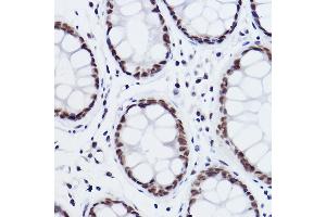 Immunohistochemistry of paraffin-embedded human colon carcinoma using MED4 Rabbit mAb (ABIN7268445) at dilution of 1:100 (40x lens). (MED4 anticorps)