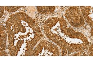 Immunohistochemistry of paraffin-embedded Human cervical cancer tissue using PDP1 Polyclonal Antibody at dilution 1:30 (PDP anticorps)