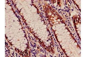 Immunohistochemistry of paraffin-embedded human colon cancer using ABIN7143250 at dilution of 1:100 (APEH anticorps  (AA 201-500))