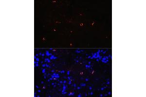 Immunofluorescence analysis of human lung cancer using Lysozyme (LYZ) (LYZ) Rabbit mAb (ABIN7268346) at dilution of 1:100 (40x lens). (LYZ anticorps)