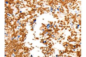 The image on the left is immunohistochemistry of paraffin-embedded Human ovarian cancer tissue using ABIN7192466(SLC2A5 Antibody) at dilution 1/12, on the right is treated with synthetic peptide. (SLC2A5 anticorps)