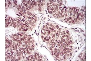 Immunohistochemical analysis of paraffin-embedded ovarian cancer tissues using PER3 mouse mAb with DAB staining.