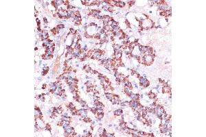Immunohistochemistry of paraffin-embedded human thyroid cancer using MRPL23 antibody (ABIN7268564) at dilution of 1:100 (40x lens). (MRPL23 anticorps  (AA 1-153))