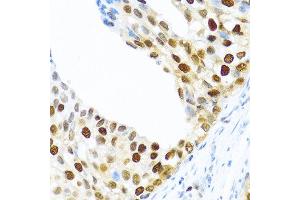Immunohistochemistry of paraffin-embedded human prostate cancer using KHDRBS2 antibody at dilution of 1:100 (40x lens). (KHDRBS2 anticorps)
