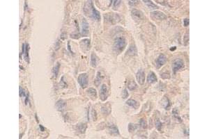 Immunohistochemical staining of formalin-fixed paraffin-embedded human lung carcinoma tissue showing cytoplasmic staining with CASP7 polyclonal antibody  at 1 : 100 dilution. (Caspase 7 anticorps  (C-Term))