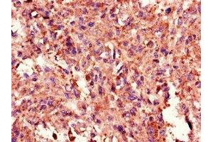 Immunohistochemistry of paraffin-embedded human melanoma using ABIN7172328 at dilution of 1:100 (TANK anticorps  (AA 4-98))
