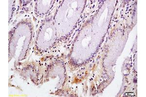 Formalin-fixed and paraffin embedded human gastric carcinoma labeled with Anti-CD72/Ly-32 Polyclonal Antibody, Unconjugated (ABIN741420) at 1:200 followed by conjugation to the secondary antibody and DAB staining