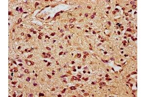 IHC image of ABIN7172459 diluted at 1:300 and staining in paraffin-embedded human glioma performed on a Leica BondTM system. (HNF1B anticorps  (AA 539-704))
