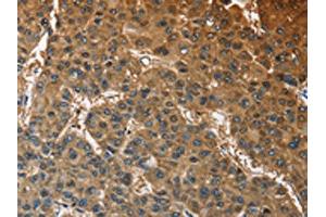 The image on the left is immunohistochemistry of paraffin-embedded Human liver cancer tissue using ABIN7128585(ATP1B2 Antibody) at dilution 1/30, on the right is treated with fusion protein. (ATP1B2 anticorps)