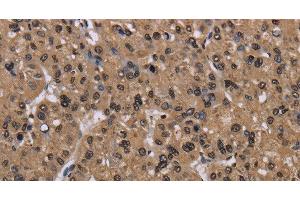 Immunohistochemistry of paraffin-embedded Human liver cancer using CSNK2A1 Polyclonal Antibody at dilution of 1:30 (CSNK2A1/CK II alpha anticorps)