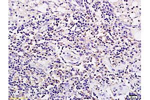 Formalin-fixed and paraffin embedded rat xenograft tumor tissue labeled with Anti SPP24/SPP2 Polyclonal Antibody, Unconjugated (ABIN1385317) followed by conjugation to the secondary antibody and DAB staining (SPP2 anticorps  (AA 55-160))
