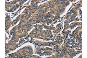 The image on the left is immunohistochemistry of paraffin-embedded Human breast cancer tissue using ABIN7192349(SH2B2 Antibody) at dilution 1/30, on the right is treated with synthetic peptide. (SH2B2 anticorps)