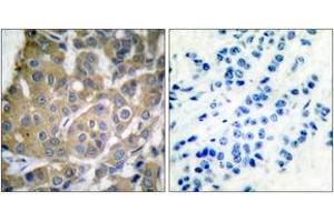 Immunohistochemistry analysis of paraffin-embedded human breast carcinoma tissue, using Cox2 Antibody.