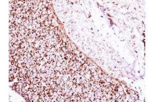 IHC-P Image Immunohistochemical analysis of paraffin-embedded human breast cancer, using Glutamate Dehydrogenase, antibody at 1:250 dilution.