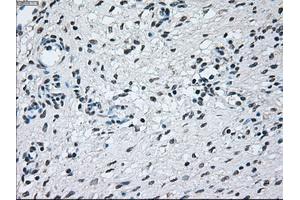 Immunohistochemical staining of paraffin-embedded Adenocarcinoma of colon tissue using anti-BRAFmouse monoclonal antibody. (BRAF anticorps)