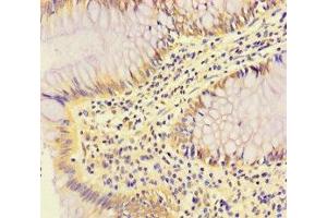 Immunohistochemistry of paraffin-embedded human colon cancer using ABIN7166969 at dilution of 1:100 (RABEP2 anticorps  (AA 301-533))