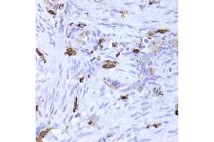 Immunohistochemistry of paraffin-embedded Human adenomyosis using LSP1 antibody at dilution of 1:100 (x400 lens). (LSP1 anticorps)