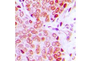 Immunohistochemical analysis of ZNF134 staining in human prostate cancer formalin fixed paraffin embedded tissue section. (ZNF134 anticorps  (Center))