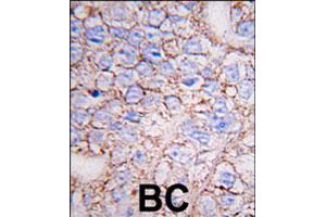 Formalin-fixed and paraffin-embedded human breast carcinoma tissue reacted with MAPK15 polyclonal antibody  , which was peroxidase-conjugated to the secondary antibody, followed by DAB staining. (MAPK15 anticorps  (N-Term))