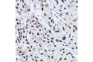 Immunohistochemistry of paraffin-embedded human esophageal cancer using [KO Validated] NCO Rabbit pAb (ABIN6129656, ABIN6144413, ABIN6144414 and ABIN7101354) at dilution of 1:100 (40x lens). (NCOA2 anticorps  (AA 550-820))