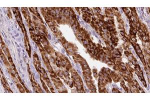 ABIN6267130 at 1/100 staining Human thyroid cancer tissue by IHC-P. (KRT20 anticorps  (pSer13))