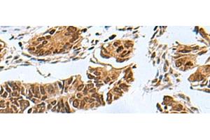 Immunohistochemistry of paraffin-embedded Human colorectal cancer tissue using PDCD5 Polyclonal Antibody at dilution of 1:55(x200)