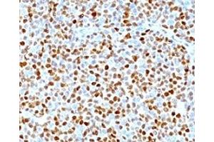 Formalin-fixed, paraffin-embedded human mantle cell lymphoma stained with CCND1 antibody. (Cyclin D1 anticorps)