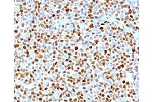 Formalin-fixed, paraffin-embedded human mantle cell lymphoma stained with CCND1 antibody. (Cyclin D1 anticorps)