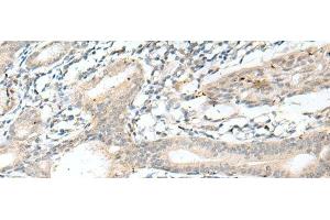 Immunohistochemistry of paraffin-embedded Human esophagus cancer tissue using NXNL1 Polyclonal Antibody at dilution of 1:45(x200) (NXNL1 anticorps)