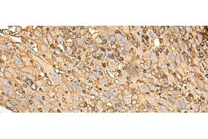 Immunohistochemistry of paraffin-embedded Human cervical cancer tissue using UBE2A Polyclonal Antibody at dilution of 1:45(x200)