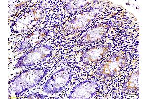 Formalin-fixed and paraffin-embedded : human colon carcinoma labeled with Rabbit Anti-WNK3 protein Polyclonal Antibody (ABIN675713), Unconjugated 1:200 followed by conjugation to the secondary antibody