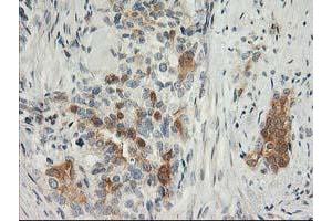 Immunohistochemical staining of paraffin-embedded Adenocarcinoma of Human breast tissue using anti-SNAP25 mouse monoclonal antibody. (SNAP25 anticorps)