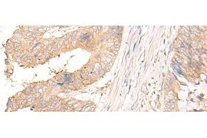 Immunohistochemistry of paraffin-embedded Human colorectal cancer tissue using MYDGF Polyclonal Antibody at dilution of 1:25(x200) (MYDGF anticorps)