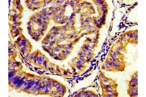 Immunohistochemistry of paraffin-embedded human endometrial cancer using ABIN7142644 at dilution of 1:100 (HTR7 anticorps  (AA 1-83))