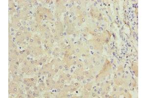 Immunohistochemistry of paraffin-embedded human liver tissue using ABIN7152640 at dilution of 1:100 (FABP1 anticorps  (AA 1-127))
