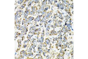 Immunohistochemistry of paraffin-embedded human lung cancer using ADSS antibody (ABIN6292806) at dilution of 1:100 (40x lens). (ADSS anticorps)