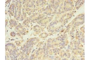 Immunohistochemistry of paraffin-embedded human breast cancer using ABIN7174025 at dilution of 1:100 (FYN anticorps  (AA 154-270))