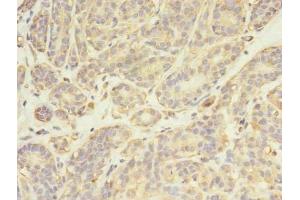 Immunohistochemistry of paraffin-embedded human breast cancer using ABIN7174025 at dilution of 1:100