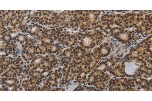 Immunohistochemistry of paraffin-embedded Human thyroid cancer tissue using SMAD7 Polyclonal Antibody at dilution 1:40 (SMAD7 anticorps)