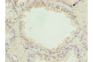 Immunohistochemistry of paraffin-embedded human prostate cancer using ABIN7158525 at dilution of 1:100 (ACSBG1 anticorps  (AA 351-600))