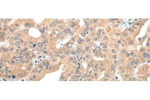 Immunohistochemistry of paraffin-embedded Human thyroid cancer tissue using CAGE1 Polyclonal Antibody at dilution of 1:35(x200) (CAGE1 anticorps)