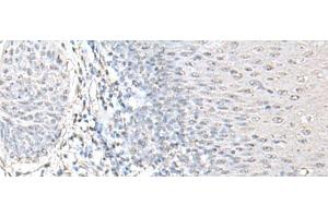 Immunohistochemistry of paraffin-embedded Human esophagus cancer tissue using EPM2A Polyclonal Antibody at dilution of 1:55(x200) (EPM2A anticorps)