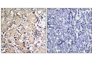 Immunohistochemical analysis of paraffin-embedded human breast carcinoma tissue using FKHR(Phospho-Ser319) Antibody(left) or the same antibody preincubated with blocking peptide(right).