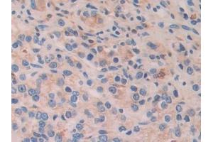 Detection of ATF4 in Human Prostate cancer Tissue using Polyclonal Antibody to Activating Transcription Factor 4 (ATF4)